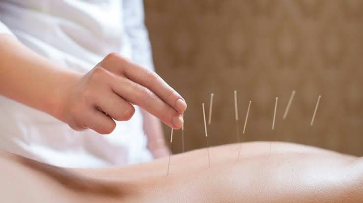 Agulhas de acupuntura aplicadas no corpo